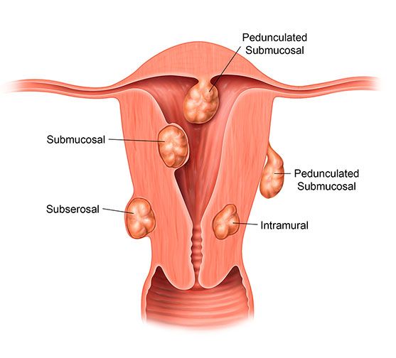 Fibroids are diagnosed by type, based on their position within the uterine wall.