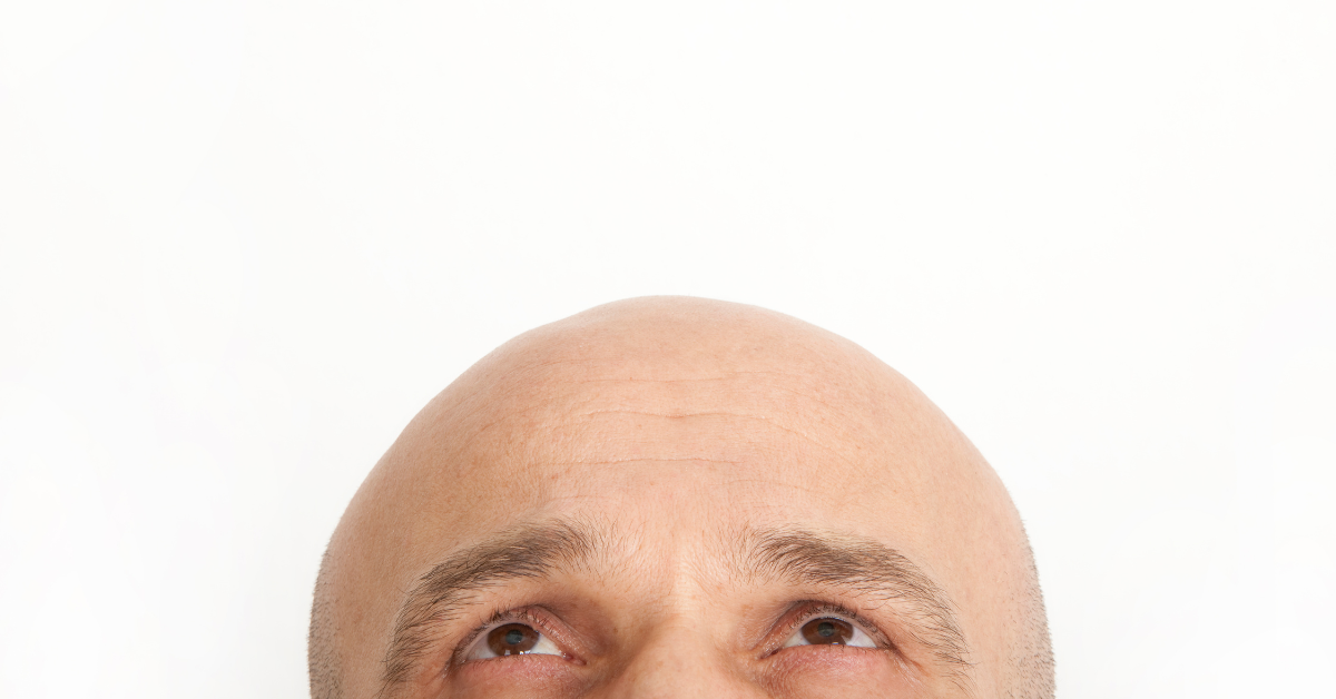 Though originally used to treat benign prostate hyperplasia,  5-alpha-reductase inhibitors are now widely prescribed to combat hair loss. 