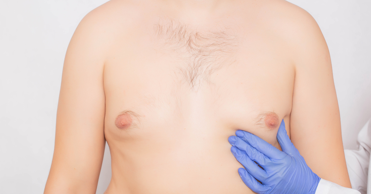 Medication used to treat the symptoms of an enlarged prostate can result in an increase in male breast tissue, known as gynecomastia.